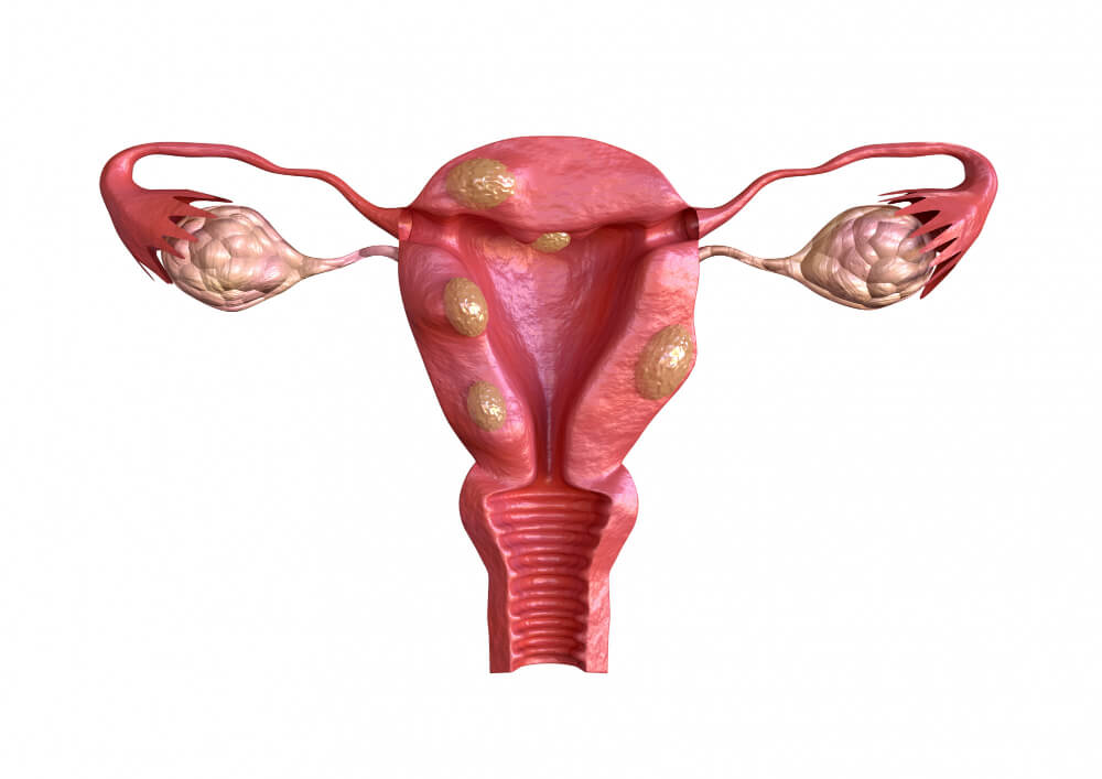 Vaginalna intraepitelna neoplazija